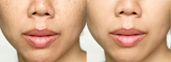 Light Over Time: Laser Removal of Age and Sun Spots for a Renewed Look